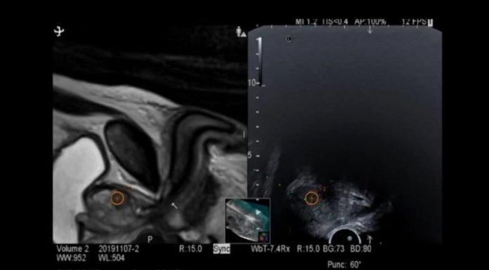 Spitalul Judetean de Urgenţă Satu Mare anunţă introducerea şi extinderea biopsiilor prostatice prin tehnica RMN-fusion