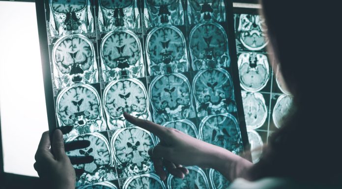 Analiză: medicamentele pentru Alzheimer nu aduc beneficii semnificative și pot crește riscurile pentru pacienți