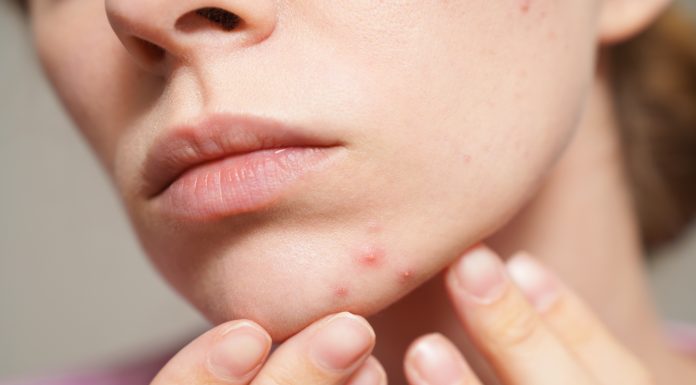 Cum pot fi evitate cicatricile după leziuni ale pielii. Specialiștii explică ce tratamente există