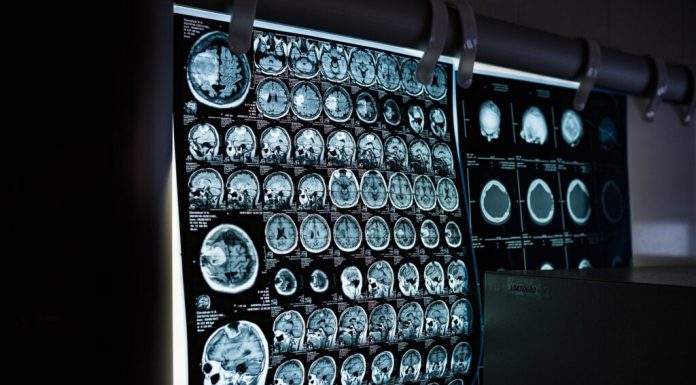 Un implant cerebral pentru depresie va fi testat pe oameni