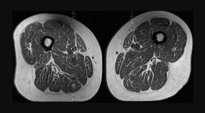Alimentele ultraprocesate „transformă” mușchii în grăsime: semnal de alarmă dintr-un nou studiu