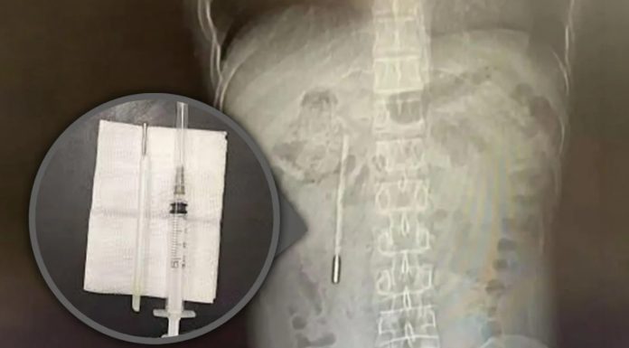 Un bărbat care acuza dureri abdominale a descoperit la spital că avea în corp un termometru înghițit în urmă cu 20 de ani