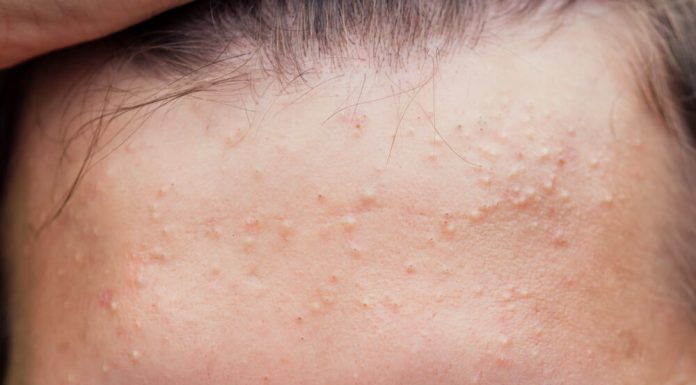 Acid salicilic pentru acnee: protocol complet în 3 pași (P)