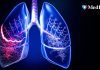 „Tusea care durează mai mult de 2 luni trebuie investigată”. Semnele bolilor pulmonare care nu ar trebui ignorate