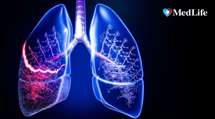 „Tusea care durează mai mult de 2 luni trebuie investigată”. Semnele bolilor pulmonare care nu ar trebui ignorate