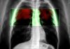Nature – Ar putea o pastilă să prevină cel mai mortal tip de cancer din lume?/ VIDEO