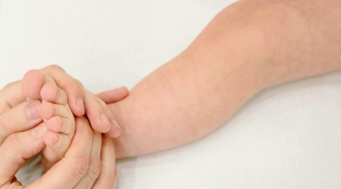 Pacienții cu dermatită atopică: efecte severe după tratamentul îndelungat cu corticosteroizi