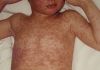 Avans important către dezvoltarea primului tratament din lume împotriva rujeolei: cercetătorii au identificat, în premieră, anticorpi umani cu potenţial de prevenire şi tratare a infecţiei cu virusul rujeolic
