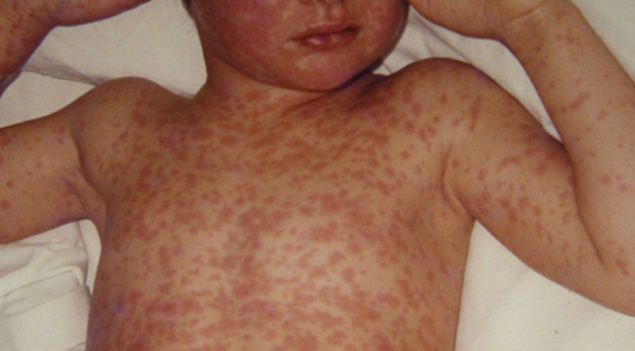 Avans important către dezvoltarea primului tratament din lume împotriva rujeolei: cercetătorii au identificat, în premieră, anticorpi umani cu potenţial de prevenire şi tratare a infecţiei cu virusul rujeolic