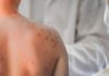Studiu: Cercetătorii au identificat anticorpi umani care pot preveni și trata infecția cu rujeolă