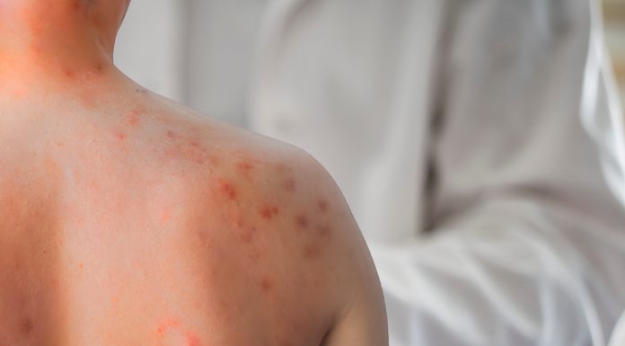 Studiu: Cercetătorii au identificat anticorpi umani care pot preveni și trata infecția cu rujeolă