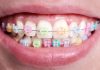 (P) Aparat dentar ceramic – confort și rezultate estetice