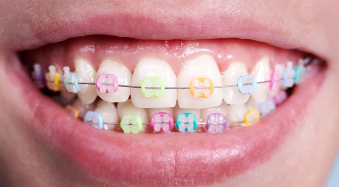 (P) Aparat dentar ceramic – confort și rezultate estetice