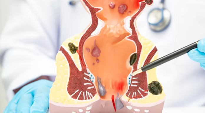 Chirurgia robotică, șansa unei femei cu cancer rectal metastatic. Medic: „Evităm colostomele în mai mult de jumătate din cazuri”