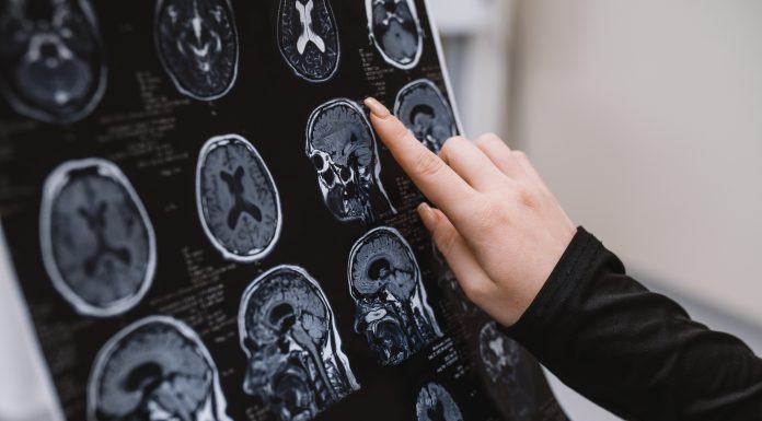 Demența începe cu „gafe” aparent banale. Medic neurolog: „Pacienții ajung, din păcate, când boala este deja coaptă”